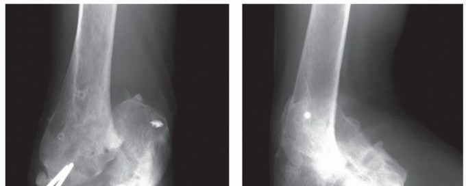 Mastering Interposition Arthroplasty for Traumatic Conditions of the Elbow