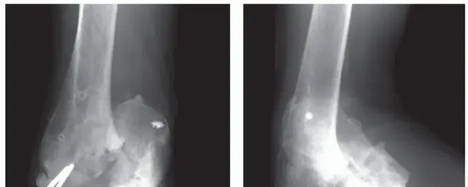 صورة توضيحية لـ دليلك الشامل لآلام وإصابات مفصل الكوع بعد الحوادث: التشخيص والعلاج مع الأستاذ الدكتور محمد هطيف