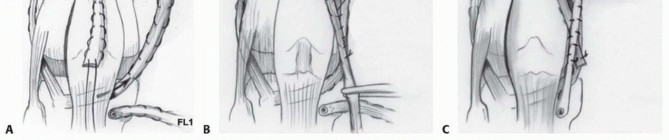 Illustration 40 for Treatment for Congenital Femoral Deficiency: What You Need to Know