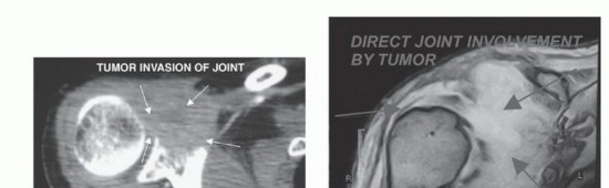 Illustration 14 for Limb-Sparing Resections Around the Shoulder: Optimizing Outcomes