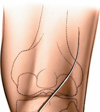 Illustration 174 for Mastering Knee Approaches: Spotlight on Superficial Medial Ligament