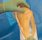 Illustration 6 for Optimizing Single-Bundle Anterior Cruciate Ligament Repair