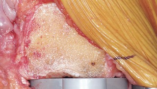 Illustration 45 for Mastering Valgus Total Knee Replacement: Techniques & Pitfalls