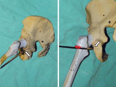 صورة توضيحية لـ إتقان توازن الأنسجة الرخوة لمفصل ورك صناعي مثالي: دليل شامل للمرضى مع الأستاذ الدكتور محمد هطيف
