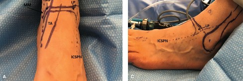 Ankle Arthroscopy: Indications, Surgical Anatomy, and Portal Planning