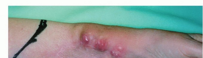 Illustration 10 for Above-Elbow & Below-Elbow Amputations: When & Why They're Needed