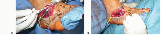 Illustration 47 for How Achilles Tendon Lengthening Fixes Equinocavovarus Foot