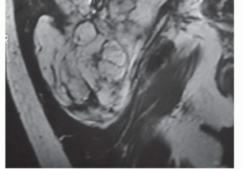 Illustration 2 for Beyond Hemipelvectomy: Preservation of the Sciatic in Buttock Surgery