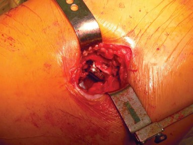 Illustration 52 for Exploring the Ambulatory Surgical Setting for Total Hip Replacement