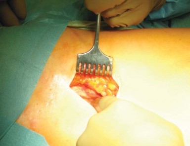 Illustration 4 for Mastering the Anterolateral Approach in Minimally Invasive Hip Replacement