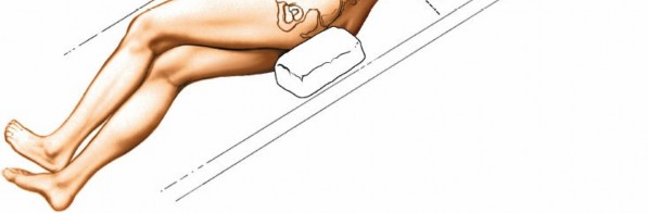 Illustration 2 for Master the Anterolateral Retroperitoneal Approach to Lumbar Spine