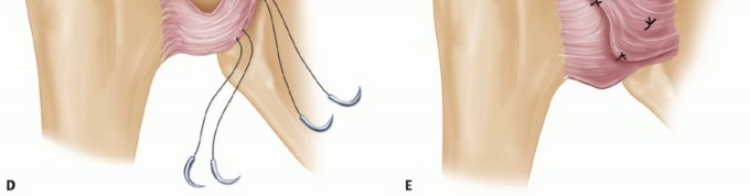 Illustration 26 for Bankart Repair & Inferior Capsular Shift: Solving Shoulder Instability