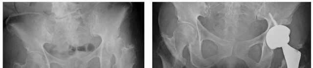 Illustration 11 for Mastering The Uncemented Socket: Ensure Lasting Hip Fixation
