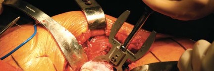 Illustration 21 for Metal on Metal Resurfacing: Enhanced Posterior Soft Tissue Repair