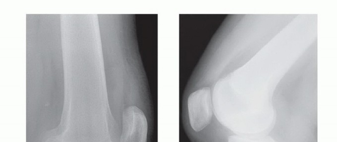 PCL Surgery Success: Why the Tibia's Aspect Matters