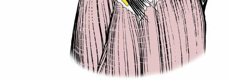 Illustration 149 for Mastering Knee Approaches: Spotlight on Superficial Medial Ligament