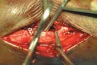 Illustration 23 for Optimal Fixation of the Ankle: Open Reduction & Internal Fixation