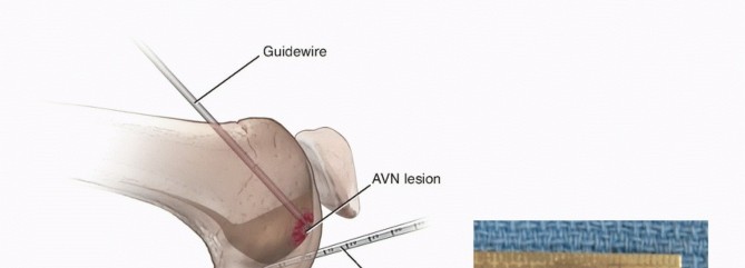 Illustration 39 for Dissecans of the Knee: What's the Difference – OCD vs. AVN?