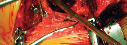 Illustration 59 for Cemented Component Longevity: The Critical Margin of the Acetabulum