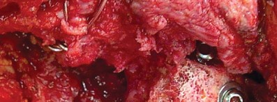 Illustration 24 for Management of Periprosthetic Fractures: An Expert Surgical Guide