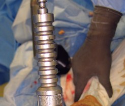 صورة طبية: استبدال مفصل الركبة بالحد الأدنى من التدخل الجراحي: ألم أقل وتعافٍ أسرع مع النهج شبه الرضفي الإنسي