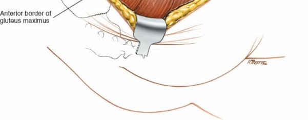 Illustration 120 for Pelvis & Acetabulum Approaches: Unlocking the Posterior Superior Iliac