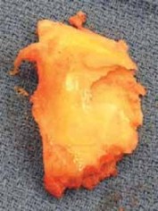 Illustration 12 for Knee Arthroplasty Unicondylar: Discover if Partial Knee Replacement is Right