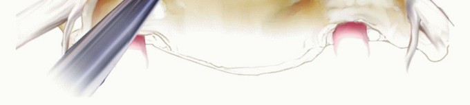 Illustration 15 for Stop Numbness & Instability: Corpectomy and Fusion Guide