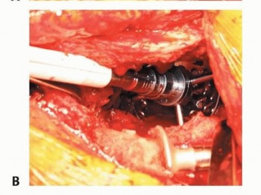 Illustration 13 for Revision Arthroplasty with Acetabular Bone Loss: The Antiprotrusio Cage