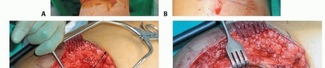 Illustration 45 for Repairing Distal Femur Fractures: Open Reduction & Internal Fixation