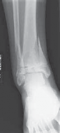 Illustration 3 for Pediatric Ankle Fractures: Management to Prevent Long-Term Issues