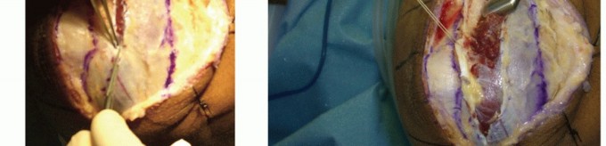 Illustration 34 for Radial Head & Neck Fractures: Mastering ORIF for Best Results