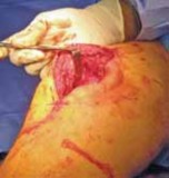 Illustration 28 for Optimal Nailing of the Tibia: Techniques for Challenging Fractures