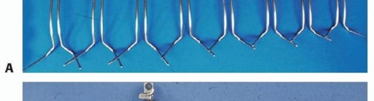 Illustration 5 for Duchenne Muscular Dystrophy: Is Spinal Fusion the Answer?