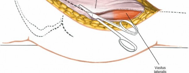 Illustration 104 for Unlocking Every Aspect of the Hip's Surgical Approaches