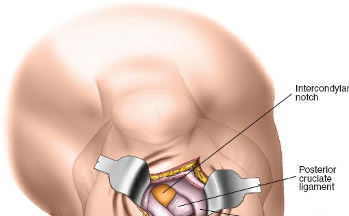 Illustration 81 for Optimal Femoral Approaches: Mastering the Lateral Intermuscular Septum