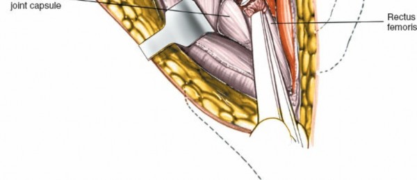 Illustration 43 for Unlocking Every Aspect of the Hip's Surgical Approaches