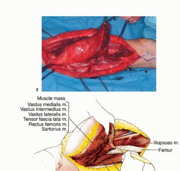 Illustration 19 for Limb-Sparing Quadriceps Resection: Superficial Femoral Artery