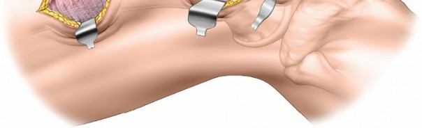 Illustration 54 for Optimal Femoral Approaches: Mastering the Lateral Intermuscular Septum