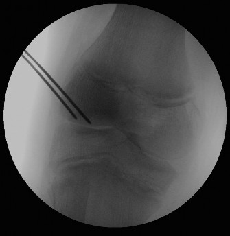 Illustration 3 for Pediatric OCD: When to Consider Drilling for the Femoral