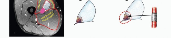 Illustration 6 for Optimizing Resection: An Overview of Surgical Approaches for Space Sarcomas