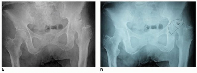 Illustration 2 for Mastering The Uncemented Socket: Ensure Lasting Hip Fixation