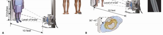 Illustration 4 for Knee Arthrodesis: A Solution for Stable Femur & Tibia Fusion