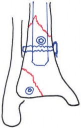 Illustration 8 for Tibial Fracture Extending into the Plafond: Intramedullary Secrets