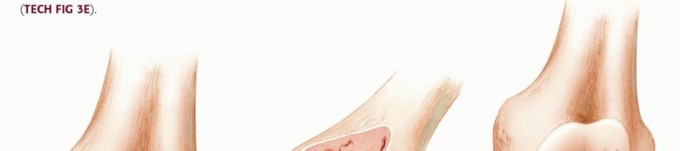 Illustration 4 for Optimizing Revision Femoral Component with Distal Femoral Bone Loss