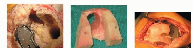 Illustration 14 for Femoral Bone Loss: Metal Augments for Revision Knee Success