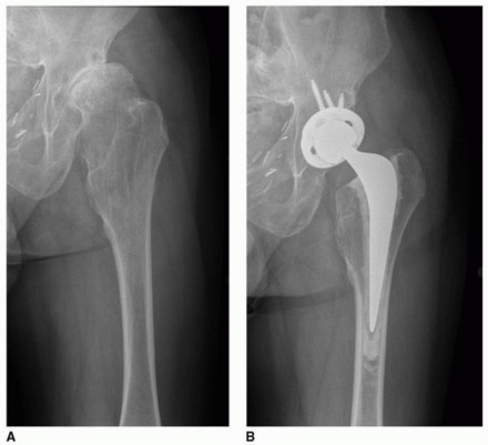 Illustration 8 for Overcoming Proximal Femoral Deformity in THA: Key Strategies