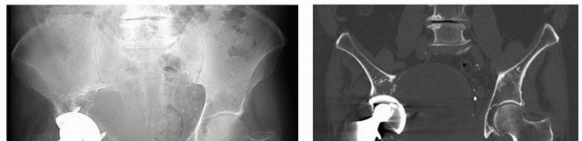 Illustration 12 for Mastering Revision THA: Strategies for Adverse Local Tissue Challenges