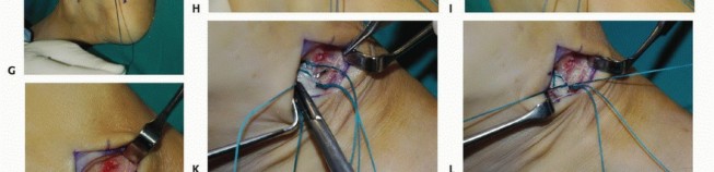 Illustration 19 for Foot Drop Surgery: How a Pin or Drill Elevates Tendon Transfer