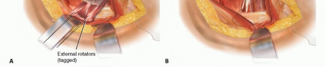 Illustration 54 for Hemiarthroplasty of the Hip: Indications & Types Explained
